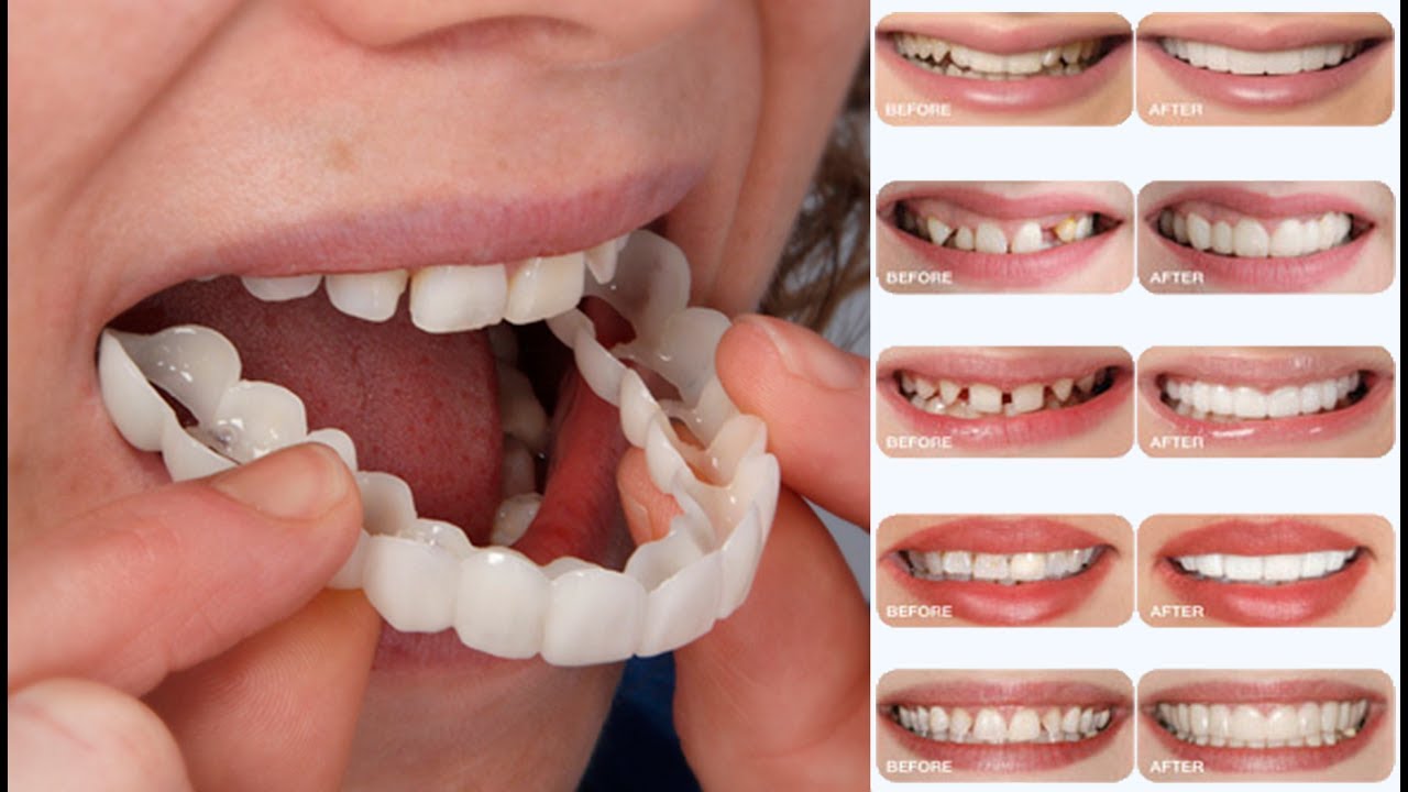  تقويم اسنان متحرك